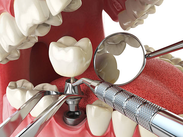 Best Emergency Dental Care for Abscessed Tooth in Crooked River Ranch, OR